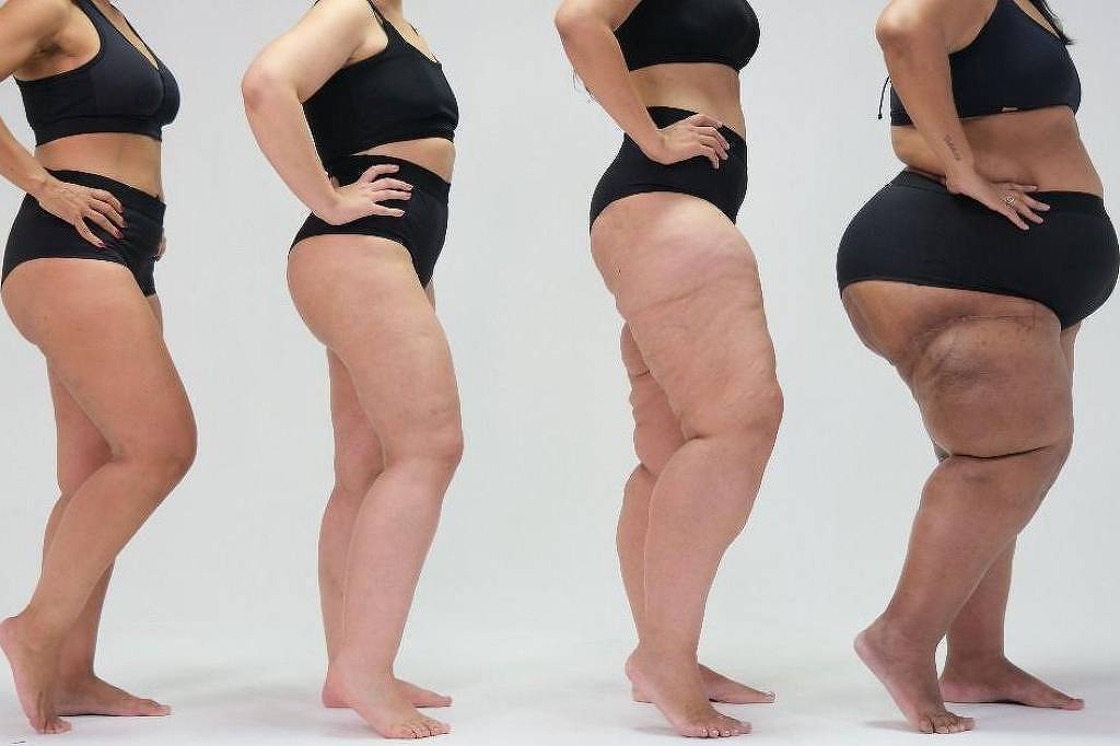 Novo estudo define critérios para diagnóstico por imagem do lipedema, que aflige 12% das brasileiras