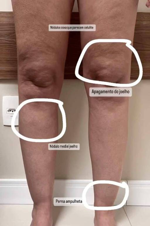 Um vídeo publicado pela médica Thais Torres， cirurgiã vascular， mostra alguns sinais visuais específicos do lipedema nas pernas