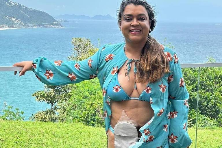 Preta Gil sorrindo em jardim， com roupa de praia， em frente ao mar; no abdômen， uma bolsa de colostomia
