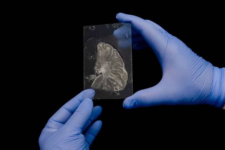 Descoberta sobre lítio pode revolucionar diagnóstico e tratamento do Alzheimer