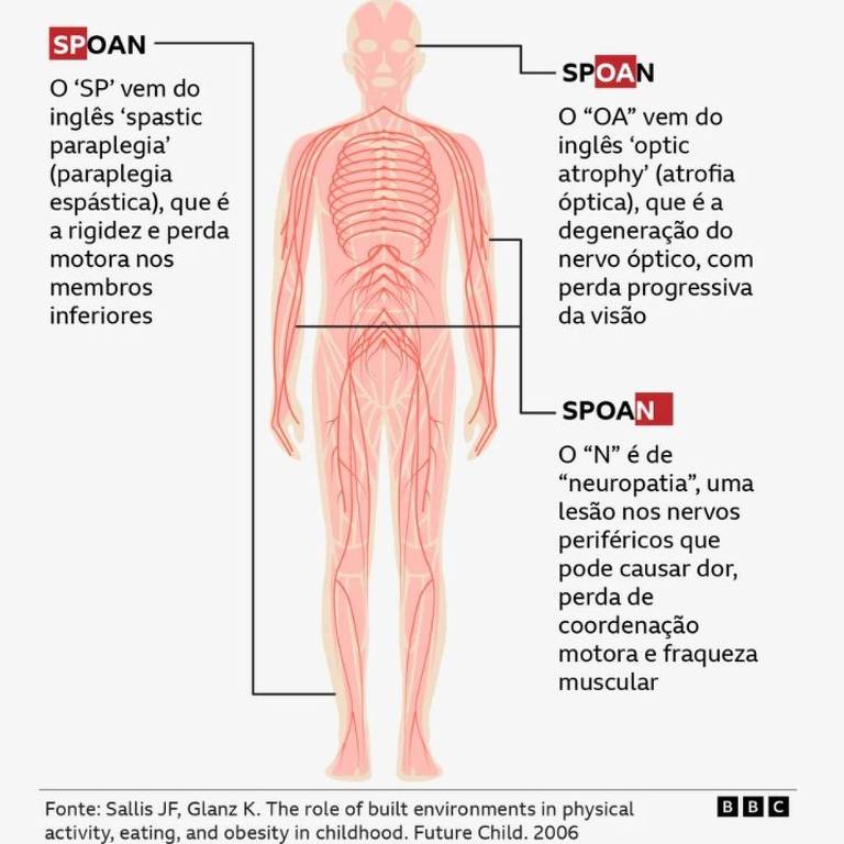 A imagem apresenta um corpo humano estilizado com linhas vermelhas， destacando os principais sintomas da doença representados pela sigla SPOAN. O texto explica que 039;S039; refere-se a paralisia espástica， 039;O039; a atrofia óptica， 039;A039; a neuropatia e 039;N039; a perda de coordenação e fraqueza muscular. A fonte da informação é citada como Sallis JF， Glanz K. de 2006.