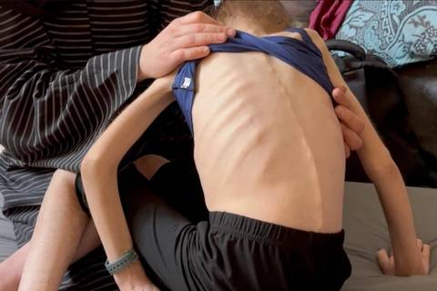 A ONU identificou 10.000l casos de desnutrição aguda entre crianças em Gaza desde janeiro