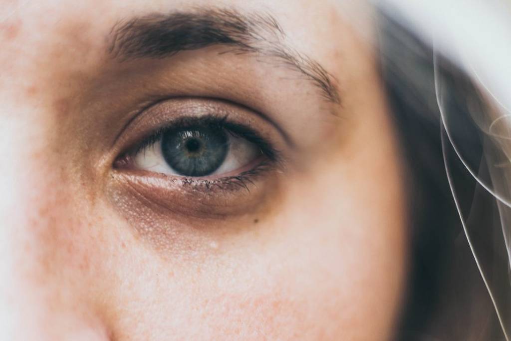 Conheça truques simples para amenizar olheiras e bolsas nos olhos