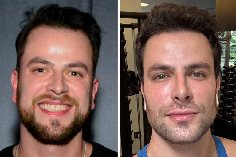Ex-BBB Gustavo Marsengo exibe antes e depois de rosto e divide opiniões de seguidores