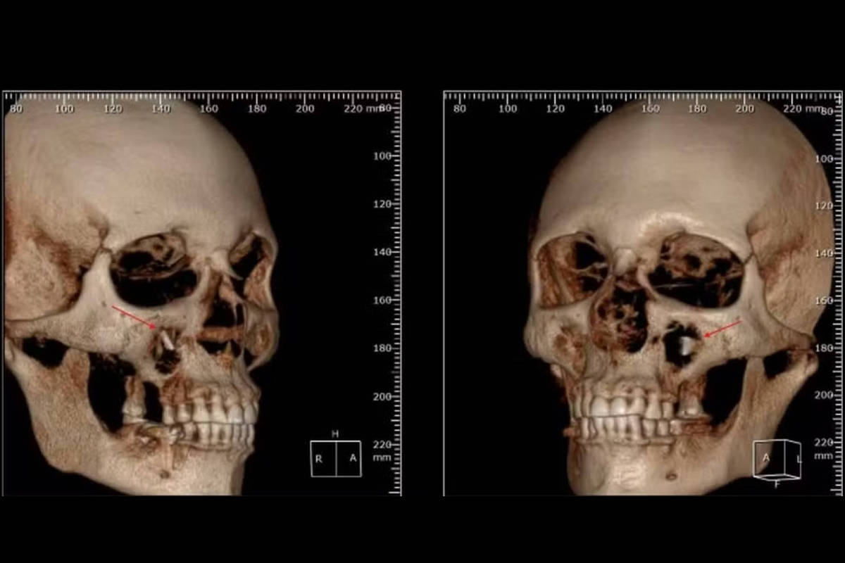 Justiça do RJ condena dentistas após paciente descobrir broca alojada no rosto