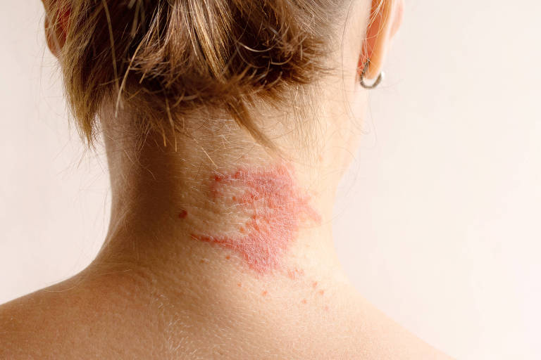 Dermatite atópica passa a ter tratamento completo no SUS após inclusão de três medicamentos