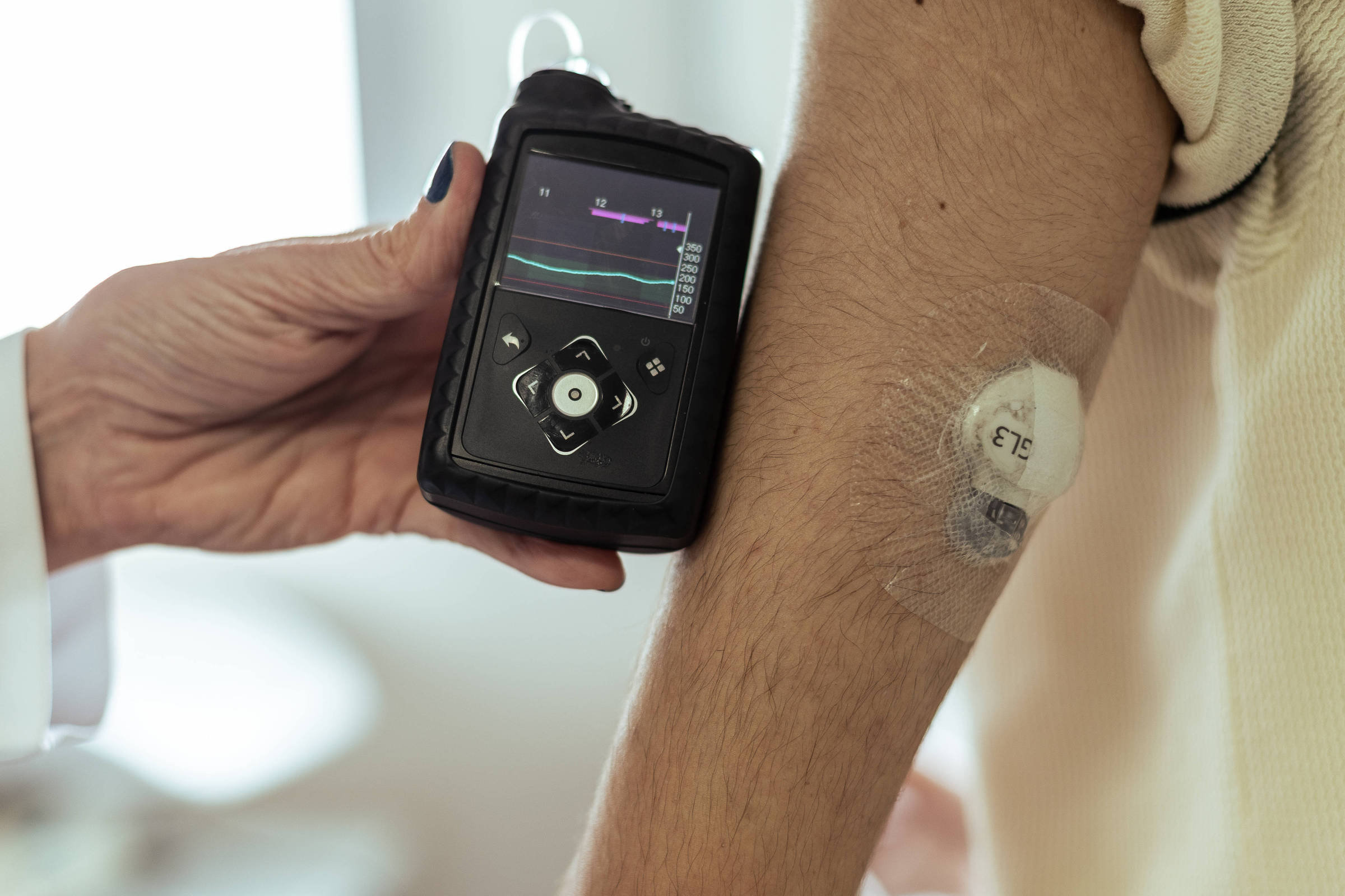 Pâncreas artificial controla diabetes e reduz picadas, mas tem preço proibitivo