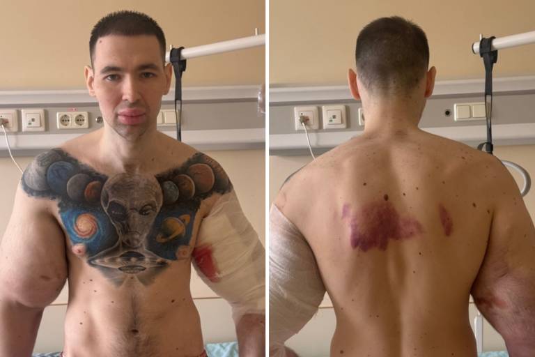 A imagem mostra um homem em um ambiente hospitalar. Ele tem um grande tatuagem no peito que representa um rosto alienígena e planetas. O homem está usando uma bermuda listrada e tem os braços enfaixados, com hematomas visíveis. A parte de trás do seu corpo também apresenta marcas roxas, indicando lesões. O fundo é uma parede com equipamentos médicos e luzes.