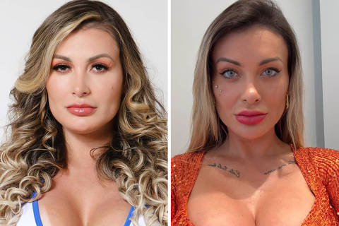 Andressa Urach revela complicações após cirurgia para mudar a cor dos olhos