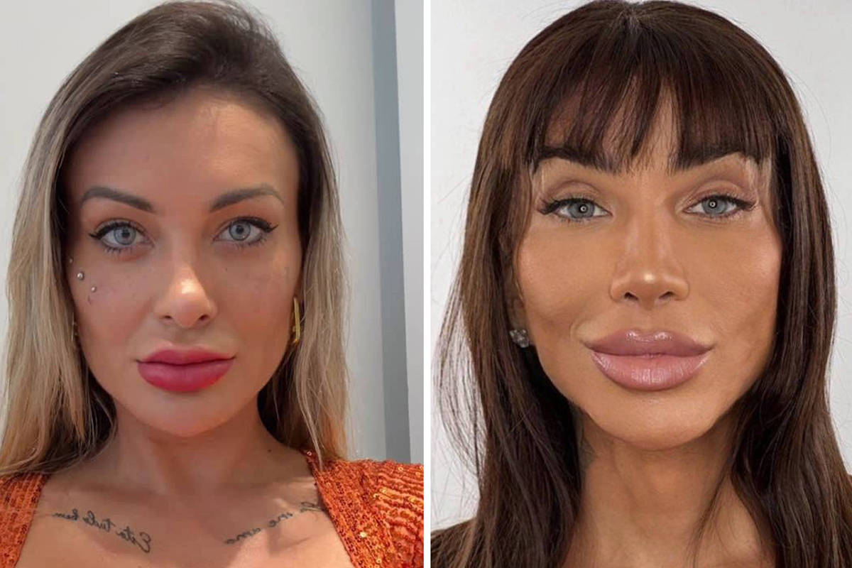 Entenda os riscos da cirurgia feita por Andressa Urach e Maya Massafera para mudar a cor dos olhos