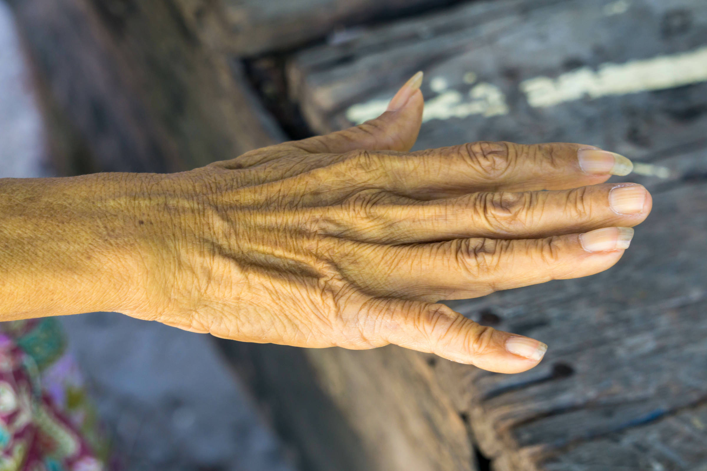 Bilirrubina, pigmento amarelado natural do corpo, pode combater a malária