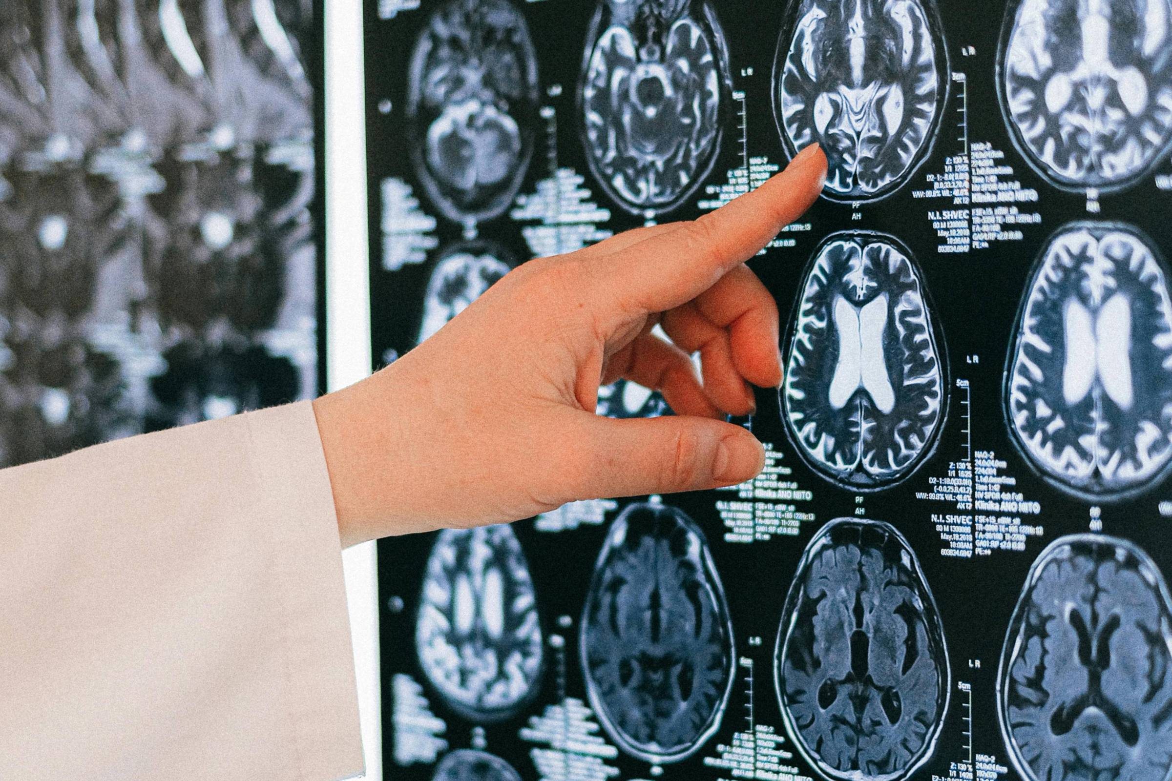 Estruturas cerebrais e sinais de psicopatia não têm relação causal direta