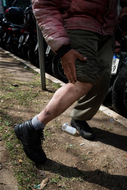 Fernando Salu, 36, entregador, mostra cicatrizes do acidente de trânsito sofrido há dois anos