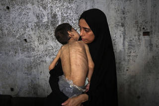 MIDEAST-GAZA CITY-CHILDREN-MALNUTRITION