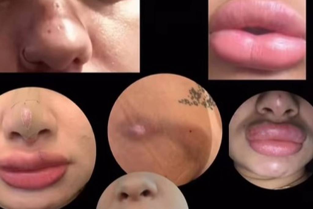 Mulheres dizem que sofreram deformações faciais após procedimentos estéticos em SC