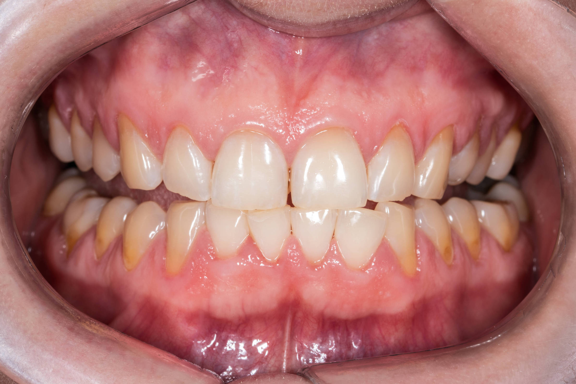 Retração gengival começa com sintomas como sensibilidade e pode evoluir até perda dos dentes