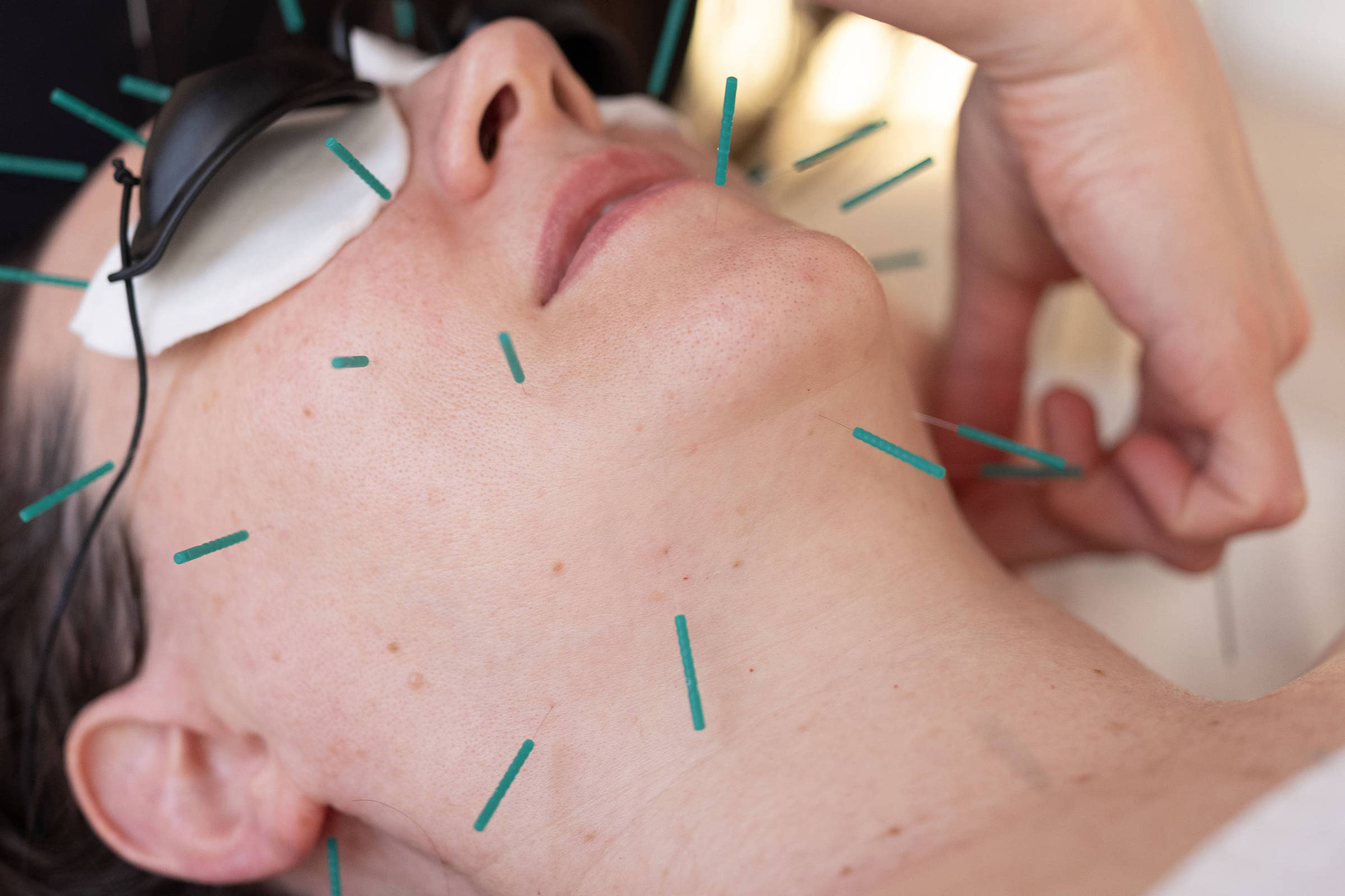 Acupuntura facial ganha popularidade como alternativa natural ao botox