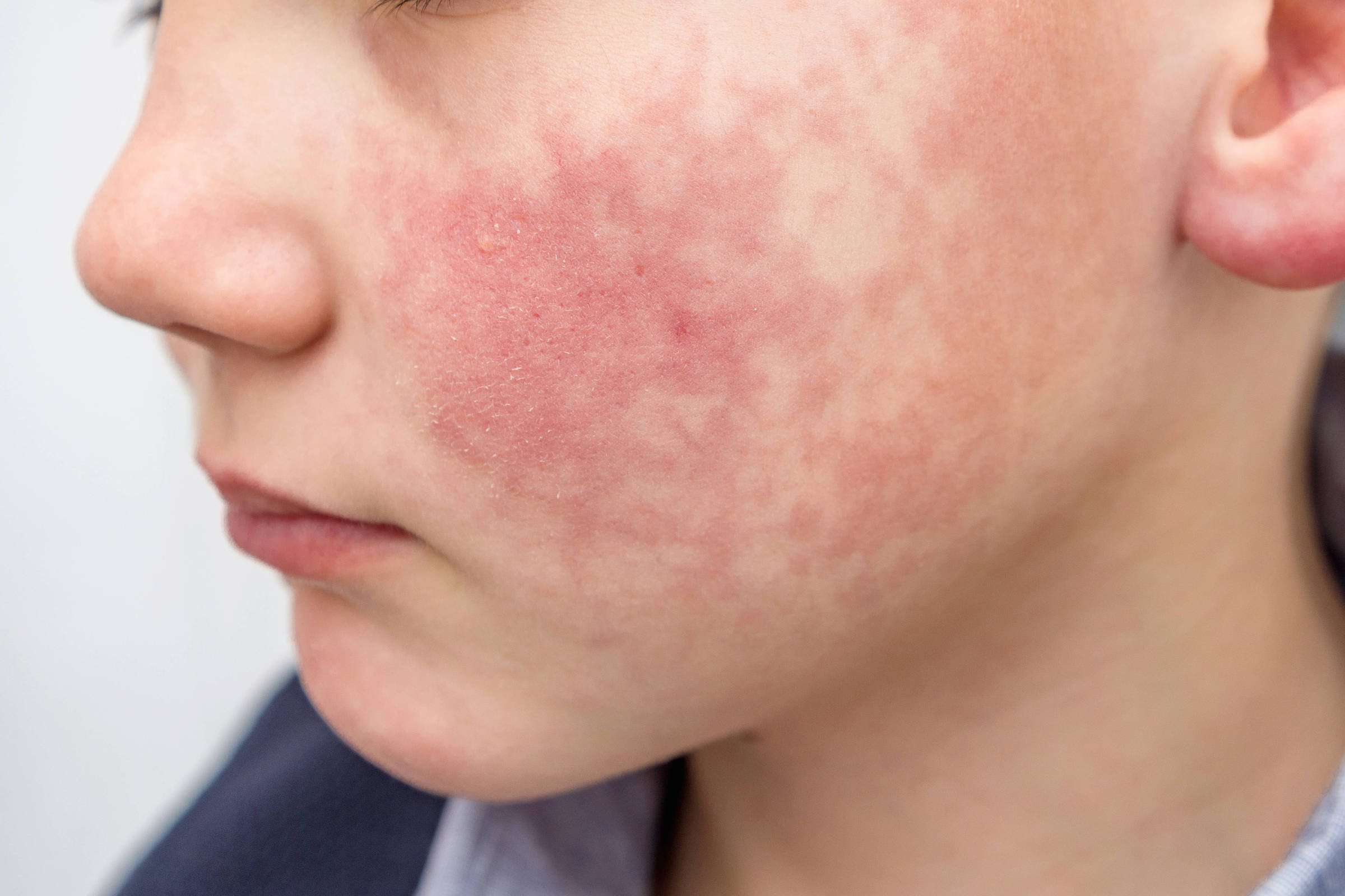 Saiba o que é o eritema infeccioso, conhecido como síndrome da bochecha vermelha