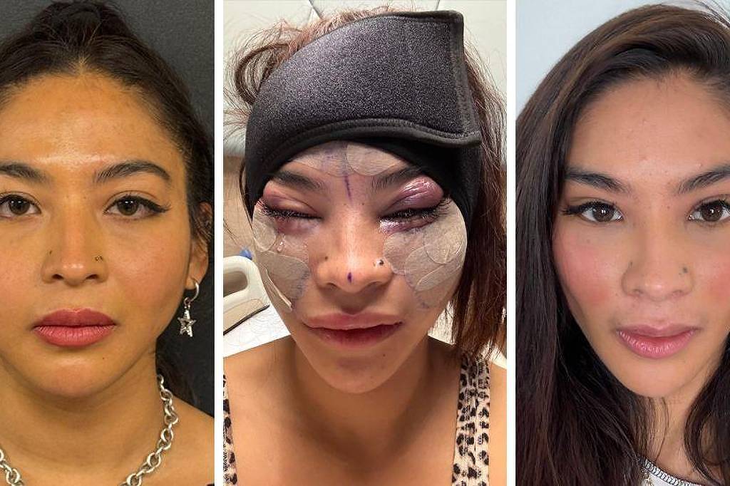 Lifting facial aos 28? Por que jovens estão recorrendo a cirurgias plásticas no rosto