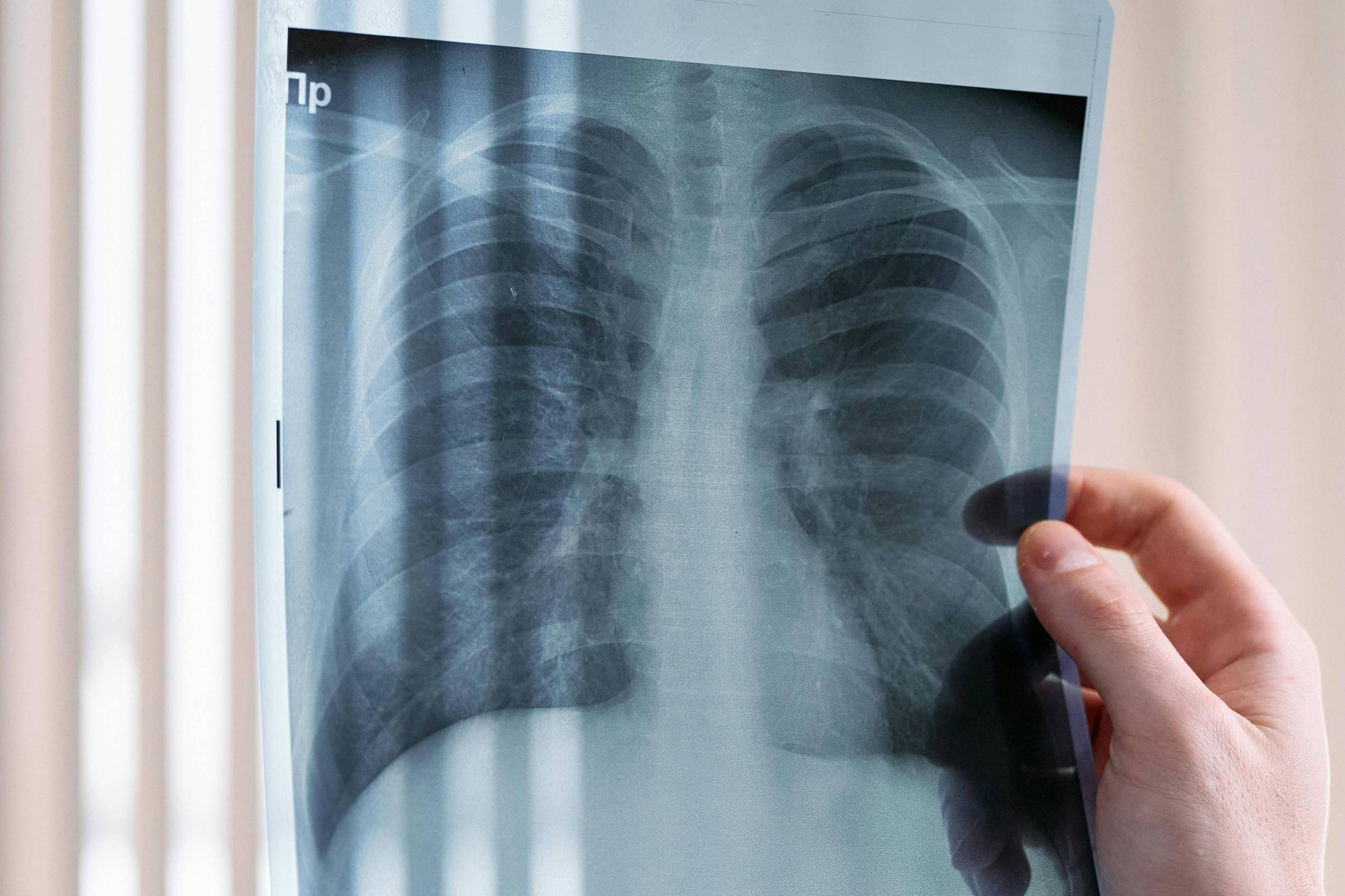 Primeira vacina contra câncer de pulmão entrará em fase de testes em 2026